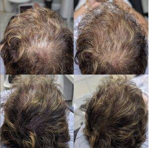 Scalp Micro Pigmentation
