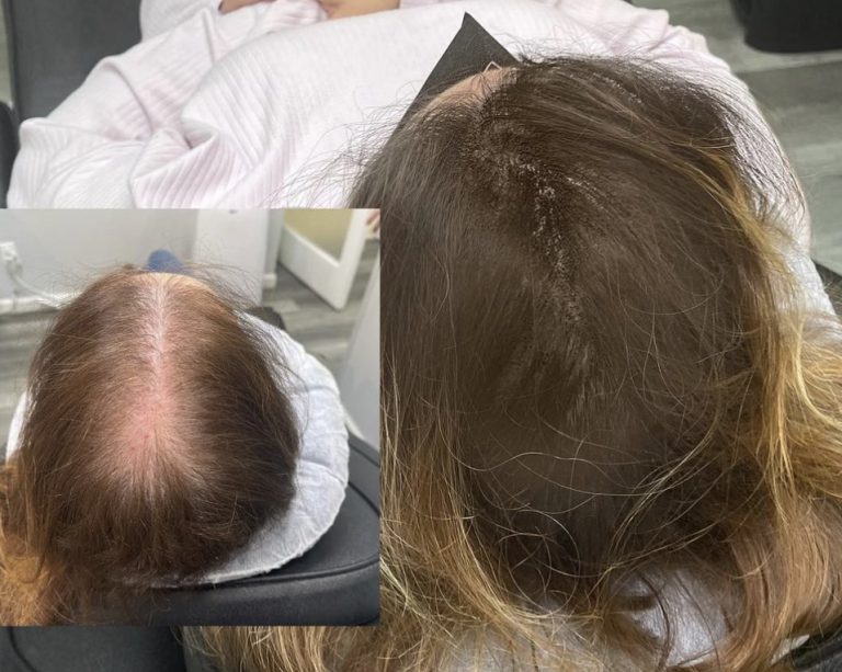 Scalp Micro Pigmentation