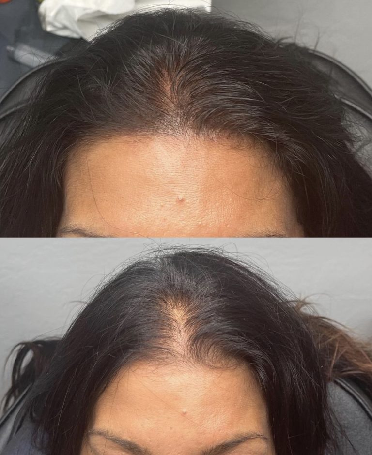 Scalp Micro Pigmentation