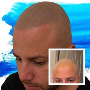 Scalp Micro Pigmentation