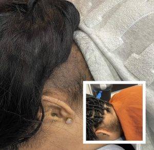 Scalp Micro Pigmentation