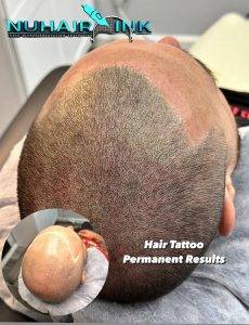 Scalp Micro Pigmentation