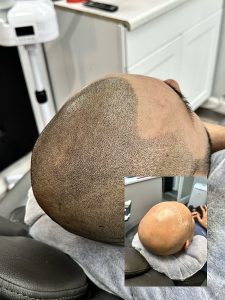 Scalp Micro Pigmentation