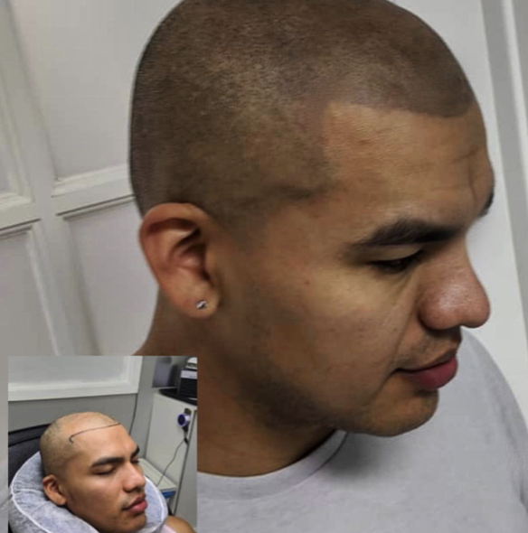 Scalp Micro Pigmentation Hair loss nuhairink.com 1