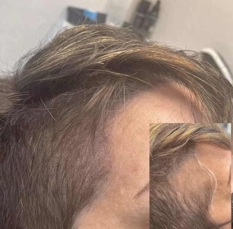 Scalp Micro Pigmentation nuhairink.com 22
