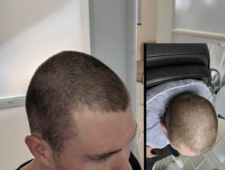 Scalp Micro Pigmentation nuhairink.com 25
