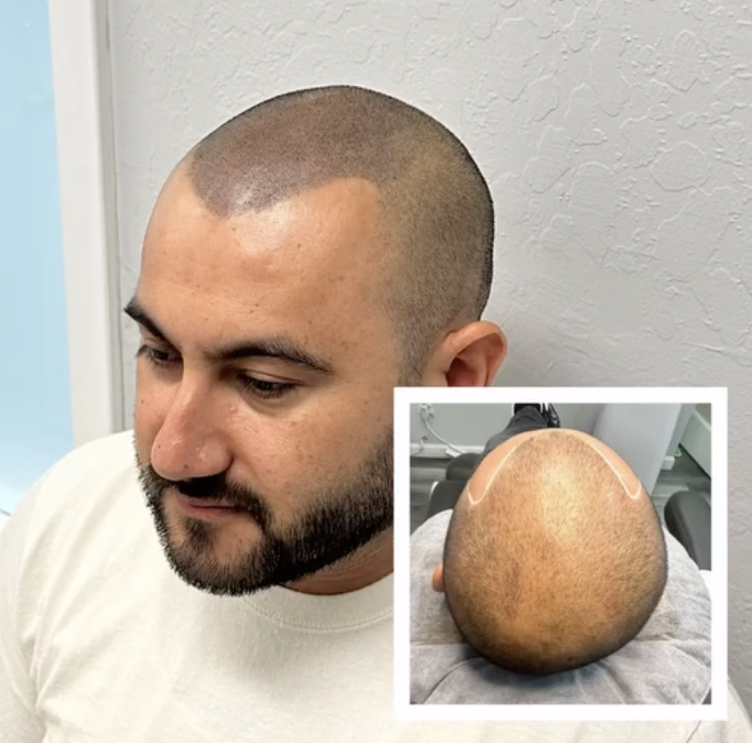 Scalp Micro Pigmentation