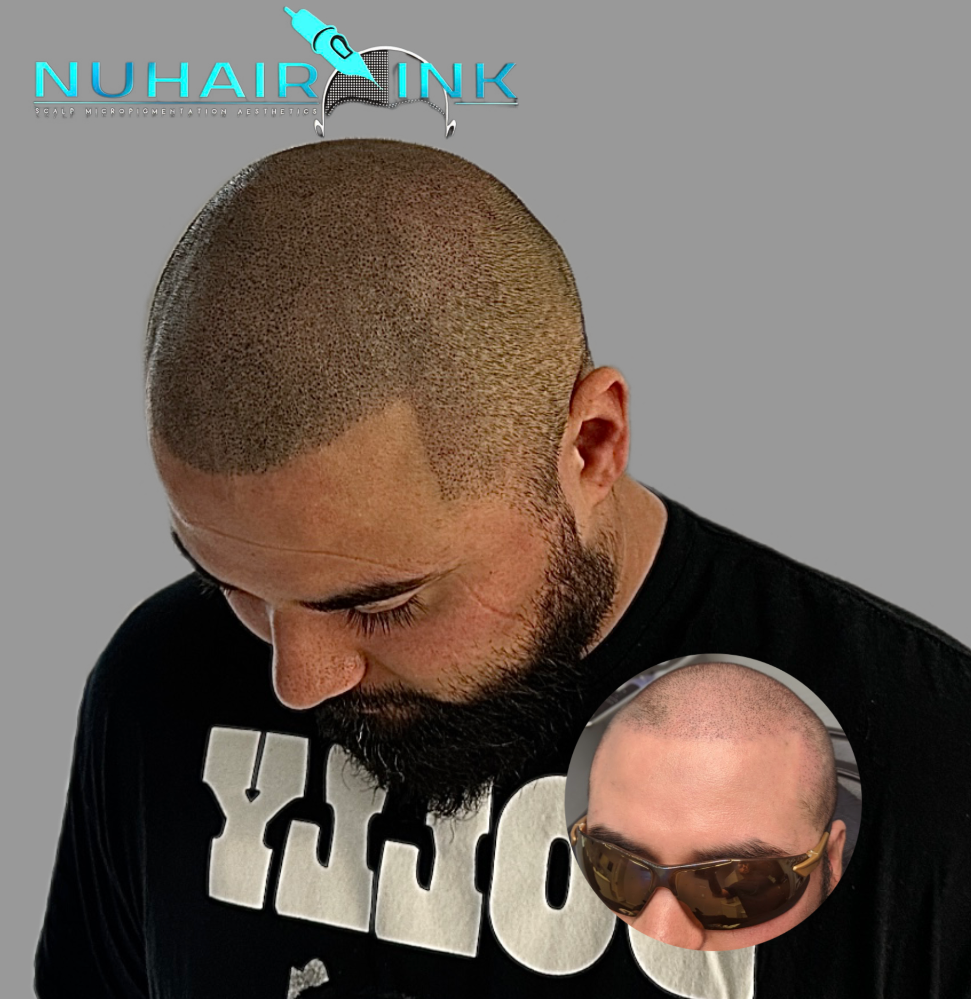 NuHair Ink clinical aesthetics photography